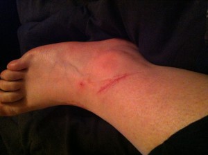 Side of right ankle.