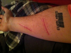 Right forearm,  2 lacerations, 16 sub stitches, 21 surface stitches total. 